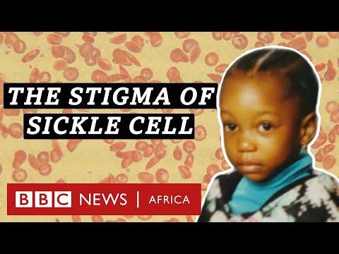 Understanding Sickle Cell Disease: Key Insights and FAQs